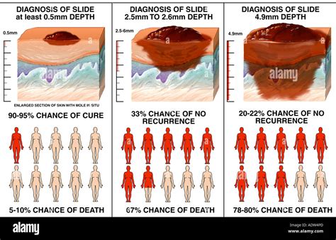 what is metastatic melanoma